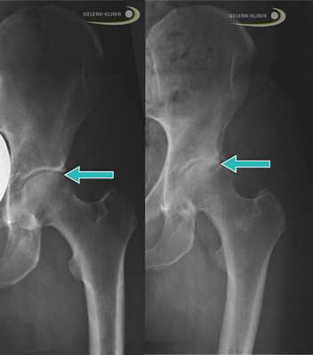Слева: Рентген здорового бедра у взрослого. Стрелой отмечена суставная щель между крышей вертлужной впадины (Acetabulum) и головкой бедренной кости (Caput femoris). Справа: Рентген тазобедренного сустава, изменённого вследствие артроза, неравномерные высветления указывают на дегенеративные изменения. © Gelenk-Klinik