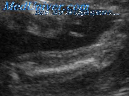 укорочение бедренной кости