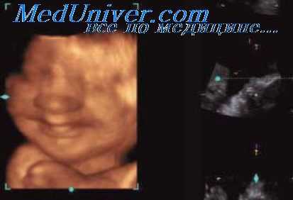 аномалия кистей плода