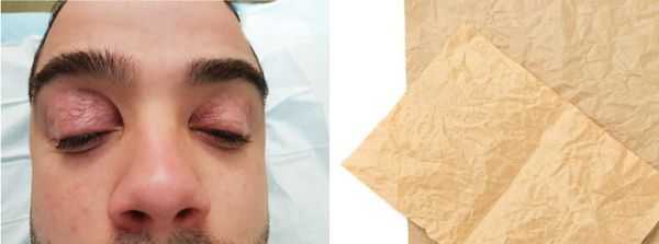 Блефарохалазис и парфинированная бумага