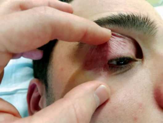 Симптомы блефарохалазиса