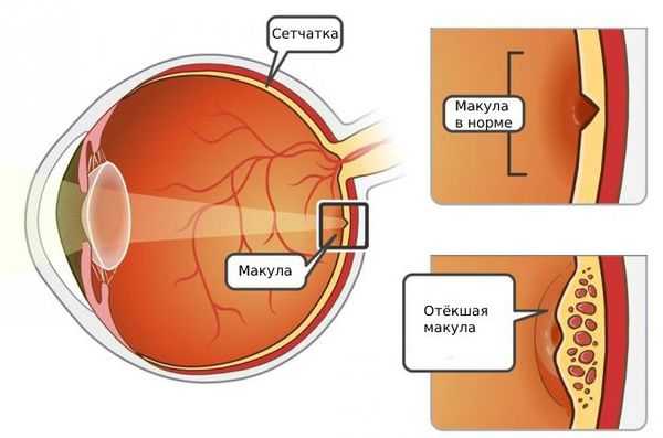 Отёк макулы