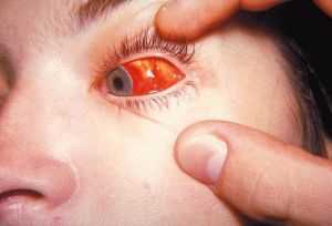 субарахноидальное кровоизлияние