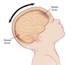 Синдром детского сотрясения