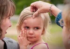 субдуральная гематома