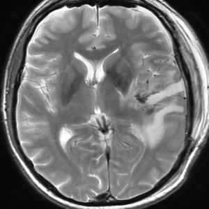 Гематома на МРТ