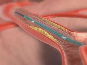 баллонная ангиопластика