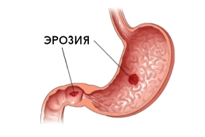 Эрозия желудка