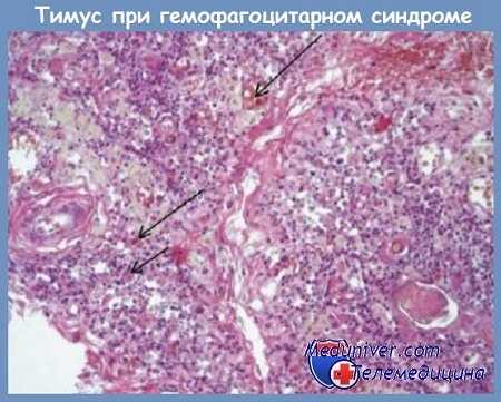 тимус при гемофагоцитарном синдроме