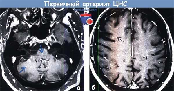 Первичный артериит ЦНС на МРТ