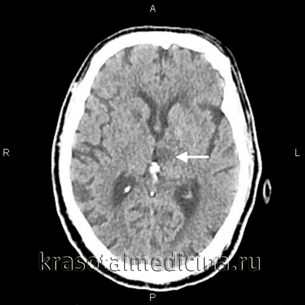 Церебральный васкулит