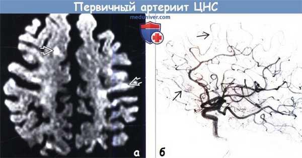 Первичный артериит ЦНС на МРТ, ангиограмме