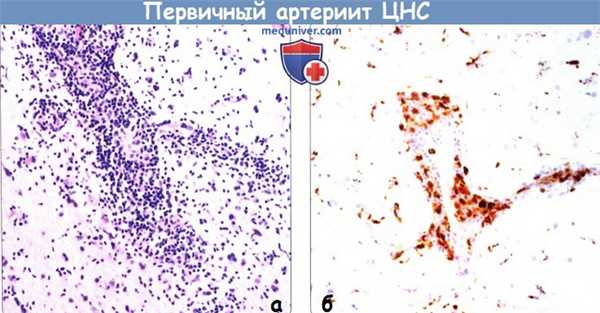 Первичный артериит ЦНС - морфология