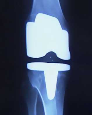 Артроз рентгеновский снимок