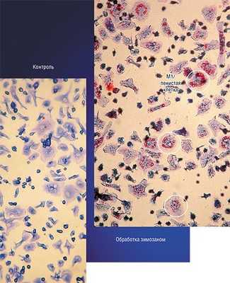 Вопреки первоначальной гипотезе, макрофаг/пенистая клетка, наполненная жировыми включениями, может формироваться даже при низкой концентрации липопротеинов – для этого достаточно лишь воспалительного процесса. Введение в перитонеальную полость мышей стимулятора воспаления зимозана, полученного из оболочек дрожжевых клеток, вызывает драматическое возрастание скорости синтеза неполярных липидов и их предшественников – жирных кислот и холестерина, которые и образуют липидные включения в макрофагах
