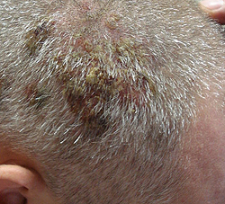 пузырчатка кожи головы в стадии корочек