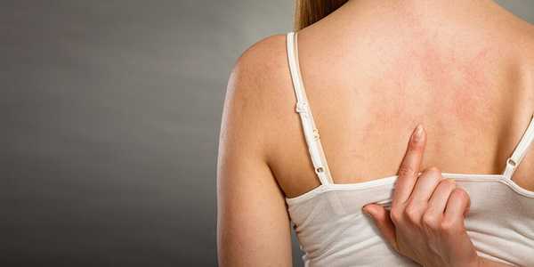 Как проявляет себя дерматит