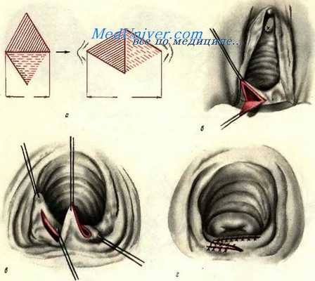 Операция при стенозе влагалища при помощи W-образной пластики