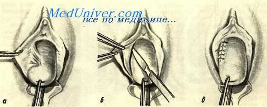 Выполнение операции по поводу стеноза влагалища