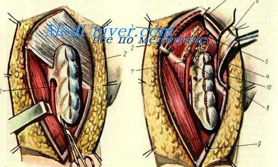 вульвэктомия