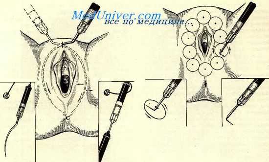 паравульварная денервация