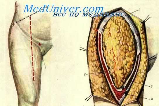 вульвэктомия