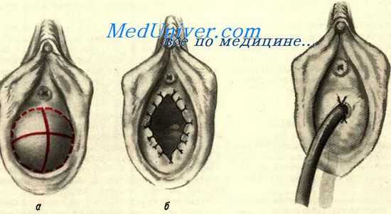 Операции на девственной плеве