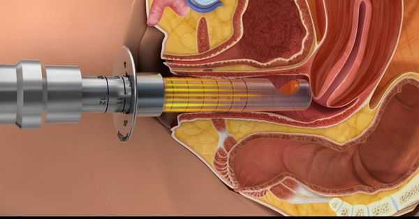 Терапия СО2 лазером