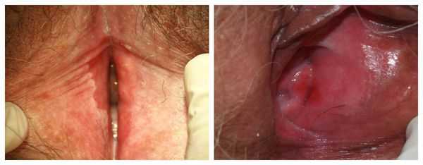 Побледнение и покраснение кожи при вульводинии