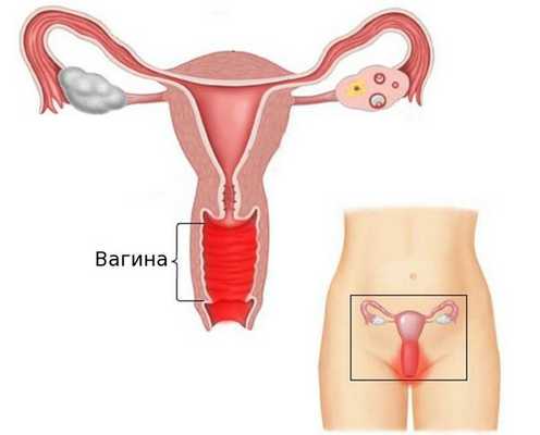 Воспаление влагалища