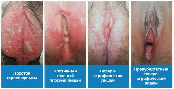 Заболевания вульвы, приводящие к вульводинии