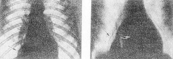 Обзорная рентгенограмма грудной клетки (а) и пневмомедиастинограмма (б) при целомической кисте перикарда: а — стрелкой указана тень кисты в правом диафрагмо-медиастинальном синусе; б — стрелка справа указывает на полоску газа, отделяющую кисту и ее ножку от сердца, стрелка слева — на оттесненную газом медиастинальную плевру.