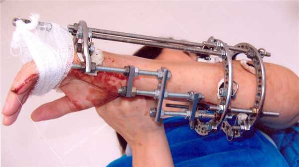 аппарат Илизарова на предплечье