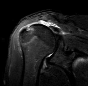 разрыв вращ манжеты-обр