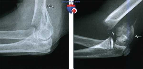 Рентгенограмма, КТ, МРТ при чрезмыщелковом (надмыщелковом) переломе локтевого сустава