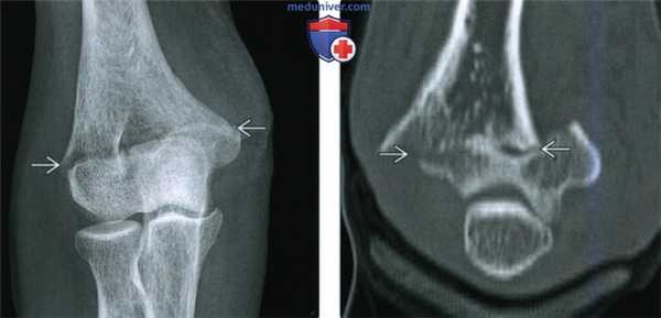 Рентгенограмма, КТ, МРТ при чрезмыщелковом (надмыщелковом) переломе локтевого сустава