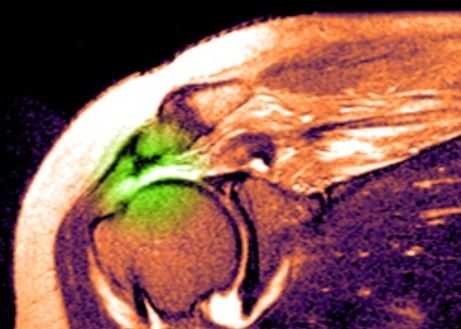 разрыв вращательной манжеты в цвете