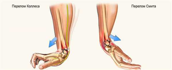 виды переломов лучевой кости