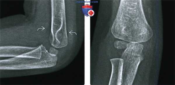 Рентгенограмма, КТ, МРТ при чрезмыщелковом (надмыщелковом) переломе локтевого сустава