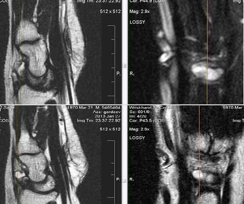МРТ кисти: когда назначается?