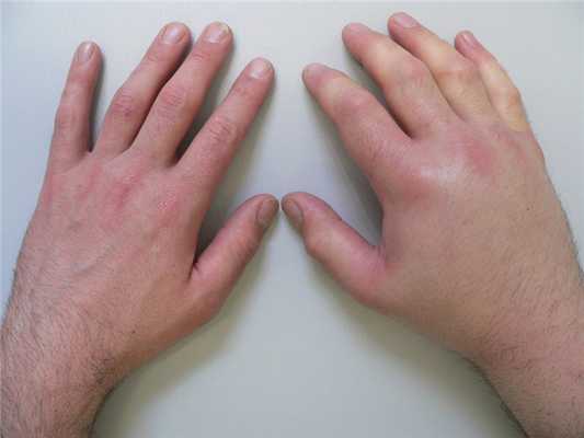 отек запястья