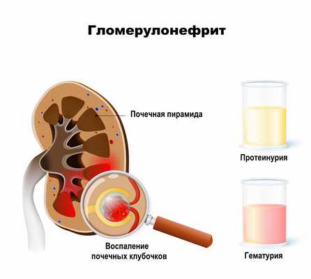 Гломерулонефрит.jpg