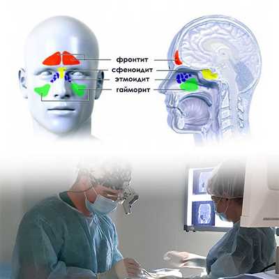 заболевания околоносовых пазух