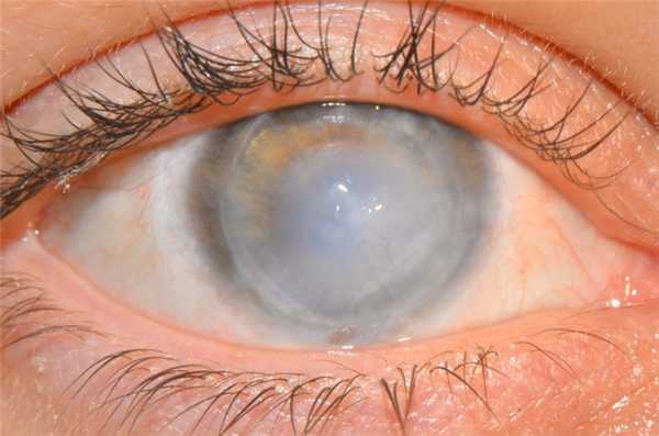 Дистрофические патологии роговицы