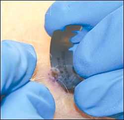 Скарификационная биопсия с помощью обычного бритвенного лезвия