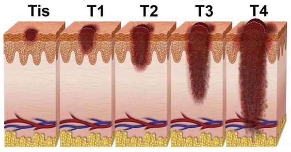 Стадии рака кожи
