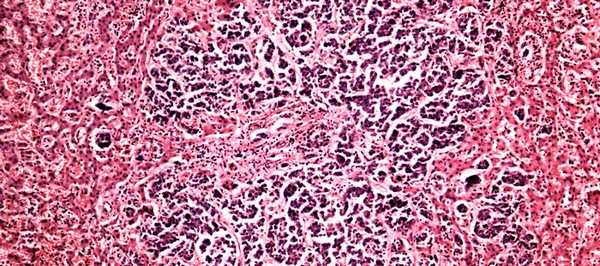 препарат рака печени под микроскопом