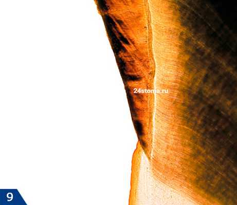 Эмалево-цементная граница (гистологический препарат)