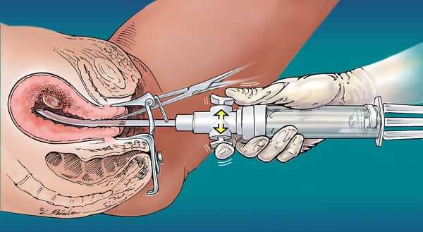 Вакуумная аспирация