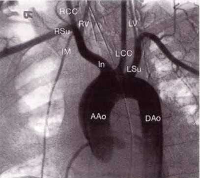 Рис. 14.2. Дуга аорты соединяет восходящий (ААо) и нисходящий отделы аорты (DАо)